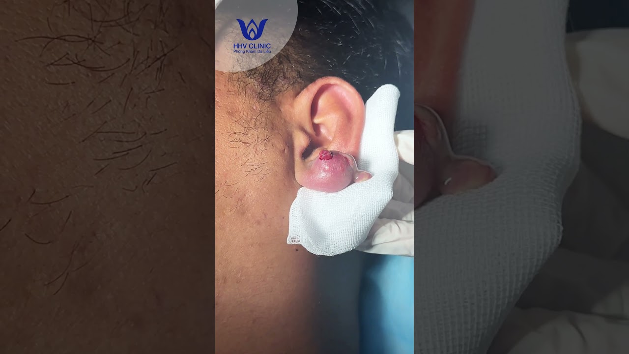 Nặn mụn u nang khổng lồ ở tai.