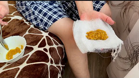 За 20 минут вся Боль Уйдёт👍Колени больше не болят!!!Рецепт
