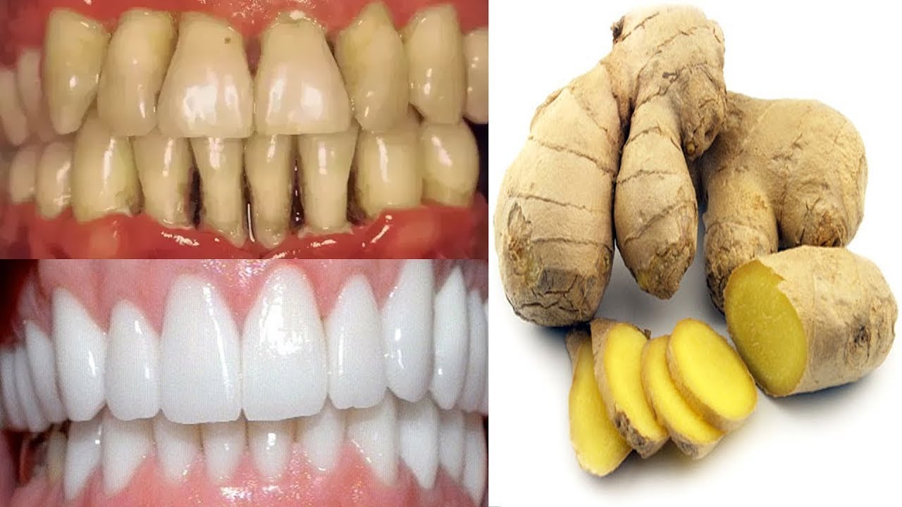Ginger for teeth whitening home remedies How to whiten teeth at home in one day YouTube