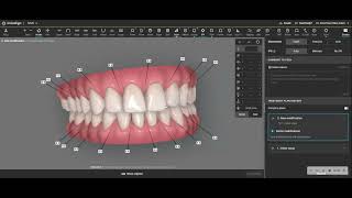 How to prevent posterior open bites with Invisalign treatment