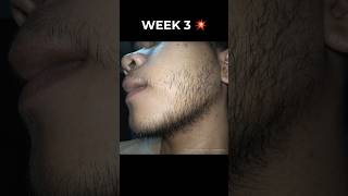 From Zero Beard To This In 3 Weeks Minoxidil Transformation