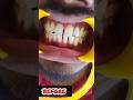 Pre wedding Smile Designing | Single day Magic #shortsfeed #smiledesigning #kerala