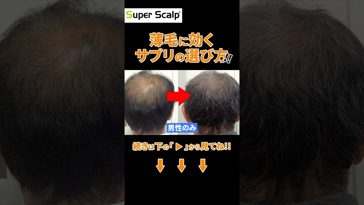 発毛促進に役立つ栄養素とは?薄毛サプリを紹介