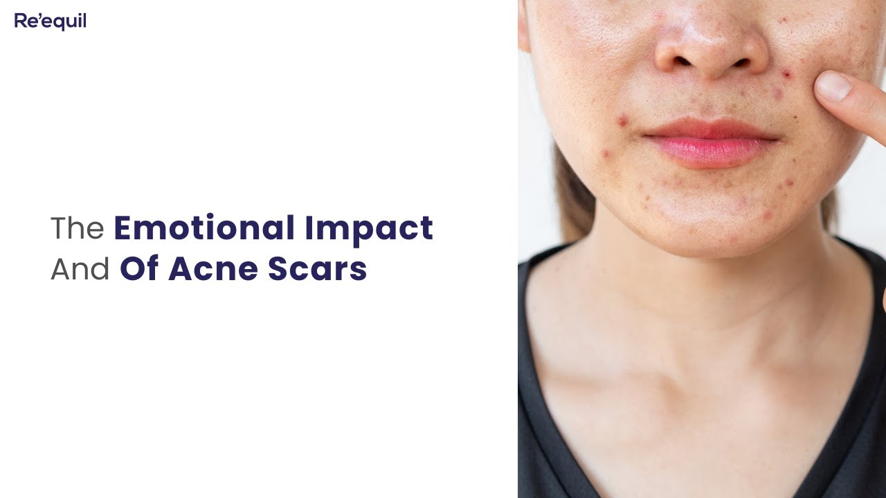 The Emotional Impact Of Acne Scars