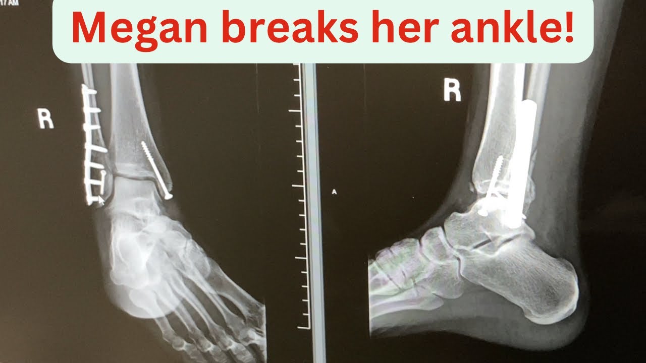Megan Breaks Her Ankle; A Recovery Adventure. A Walking Miracle!