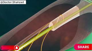 Tibia Fracture - Bone Transport With Ilizarov - Ief 3D-Animation.