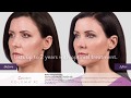 Juvederm Cheek Fillers Before And After