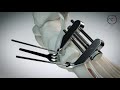 Newclip technics  footmotion plating sytem  lapidus arthrodesis by medio plantar plate