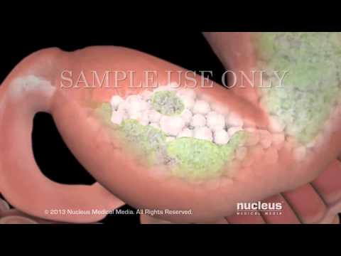 Video: Úlceras Estomacales E Intestinales En Perros