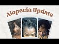 My hair is BACK!! Locs with Alopecia Update