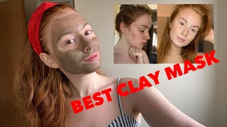 The Best Face Mask for Hormonal Acne PCOS Blemish Prone Skin Bentonite Clay ACV
