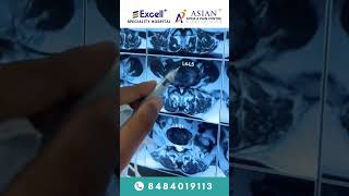 Spinal stenosis treatment by Endoscopic decompression stitchless procedure | Dr. Jagdish Patil