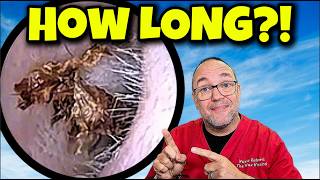 How Long?! 😱 Massive Dead Skin Ribbons Being Pulled Out! | Episode 662