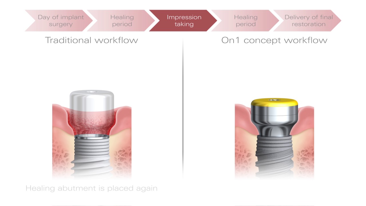 The On1 Concept The Best Of Both Worlds Nobel Biocare Youtube