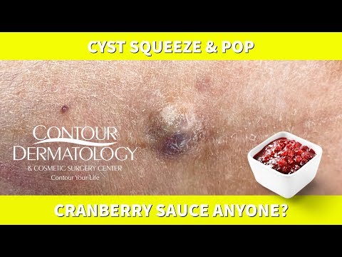 Cyst (Cranberry Sauce) Pop and Squeeze