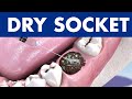 DRY SOCKET Infection After Tooth Extraction Causes And Treatment DRY SOCKET Infection After Tooth Extraction Causes And Treatment