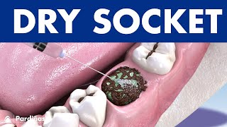 DRY SOCKET - Infection after tooth extraction: causes and treatment ©