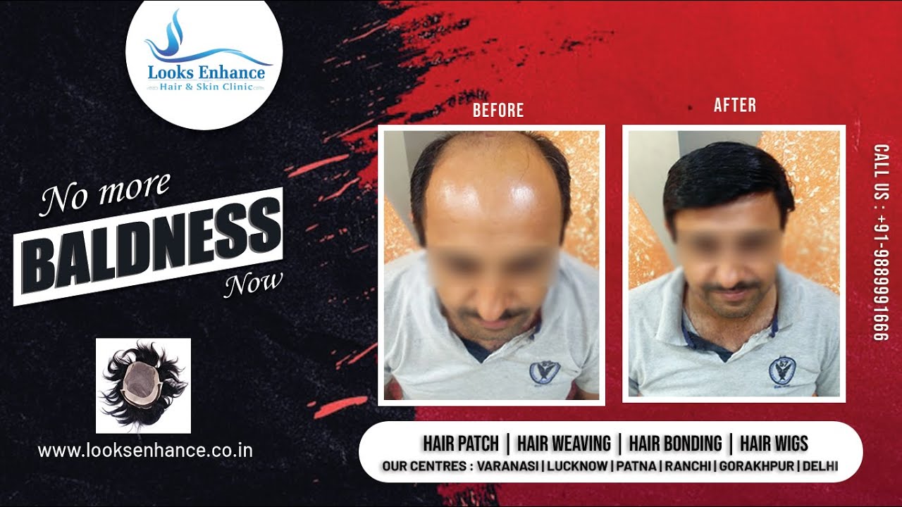 Men's Hair Patch Ranchi Hair Weaving in Ranchi Hair Bonding in