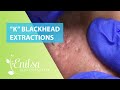 Blackheads Extractions “K’s” 3rd Treatment