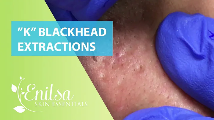 Blackheads Extractions Ks 3rd Treatment