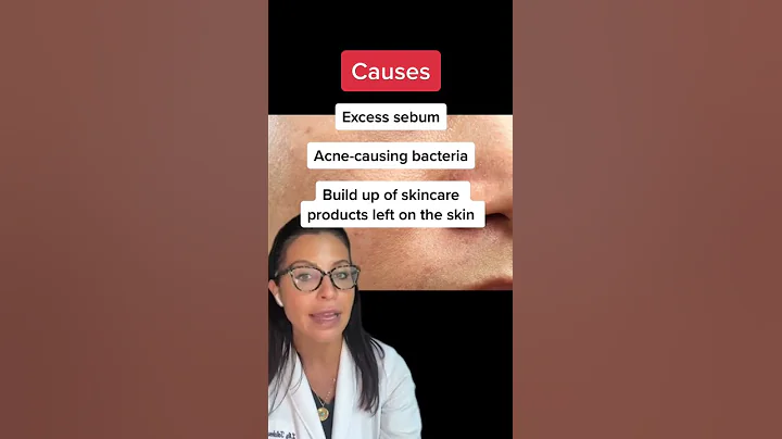 A Dermatologist Answers: What are Closed Comedones? #shorts