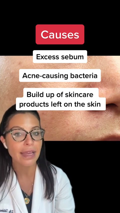 A Dermatologist Answers: What are Closed Comedones? #shorts