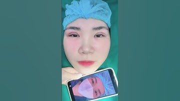 Feedback mí cực xịn của chị khách sau khi thực hiện cắt mí  #lamdep #catmi