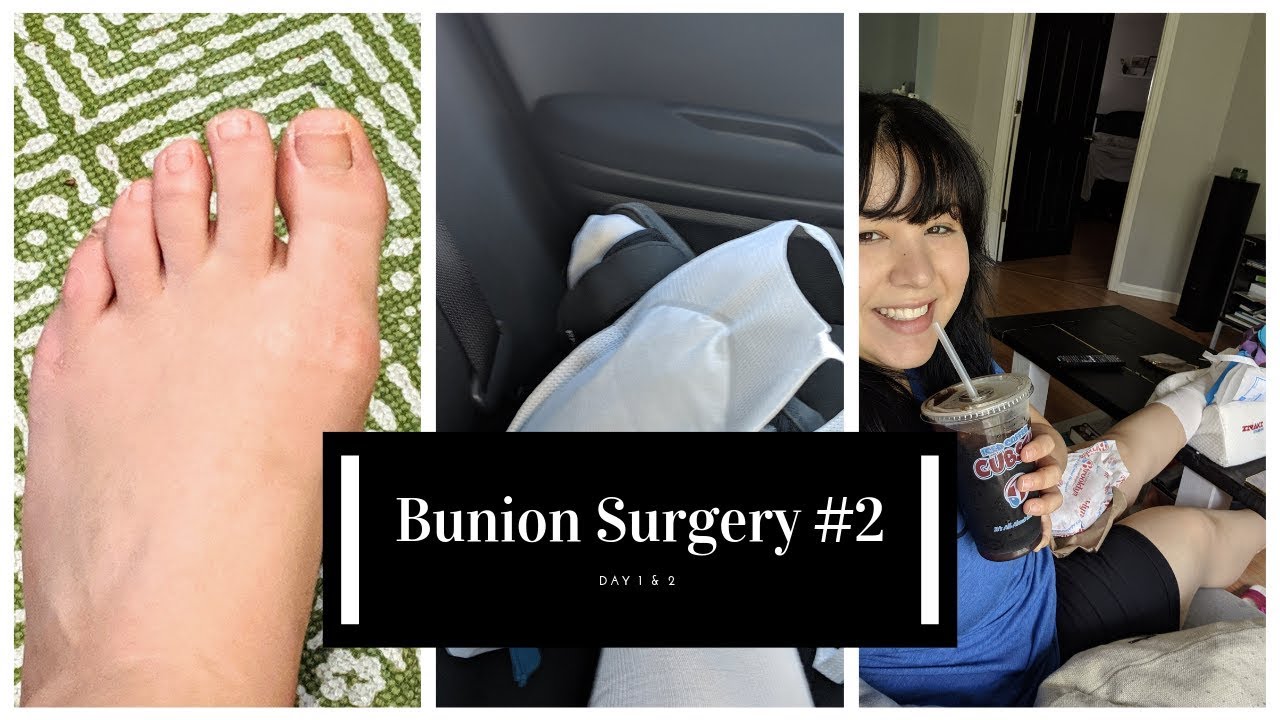 Bunion Surgery 2 YouTube
