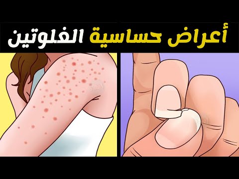 أعراض حساسية الغلوتين عند الكبار