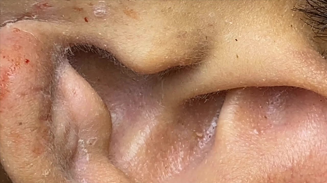 Squeezing Pimples On Ears | Nặn Mụn Trên Tai - SacDepSpa#104