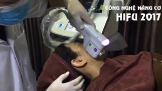 Trang Vân - Nâng Cơ Trẻ Hóa 1 Lần Duy Nhất Hifu Doublo-S 2017