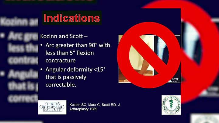 Dr. Brian T. Palumbo, Unicompartmental Knee Arthro...
