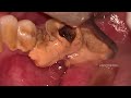 Heavy Tartar Removal