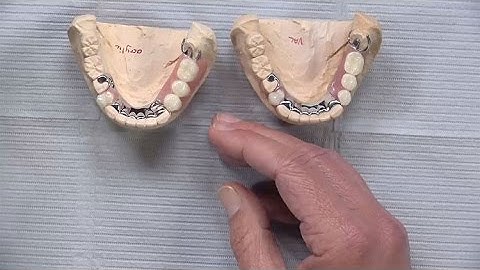 Case of the week: Esthetic Clasping Options for Partial Denture Cases