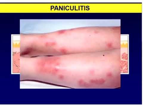 Vídeo: Eritema Nodoso - Causas E Sintomas De Eritema Nodoso