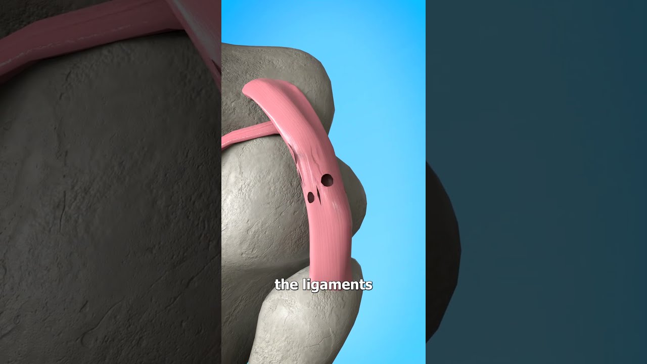 Hyperextending Your Knee Explained 