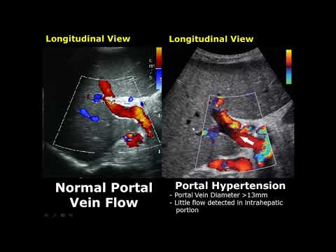 Liver Ultrasound Normal Vs Abnormal Image Appearances Comparison | Liver Pathologies USG