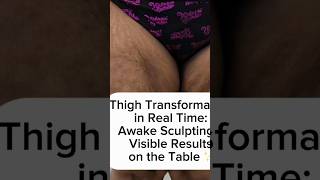 Awake Vertical Thigh Lift + VASER Liposuction + Renuvion Inner Thigh & Knee Contouring Before/After