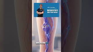 Meet the Varicose Vein 👀🦵 | Animated Reel That Explains It All