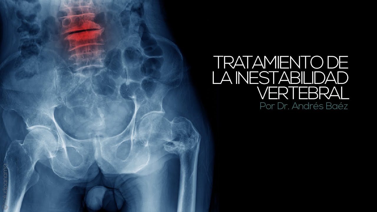 Tratamiento de la inestabilidad vertebral por Dr. Andrés Báez. - YouTube
