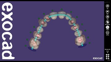 exocad Quick Guide: The "Chain Mode" Feature