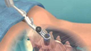Traitement chirurgical hernie discale lombaire par voie mini invasive microchirurgical