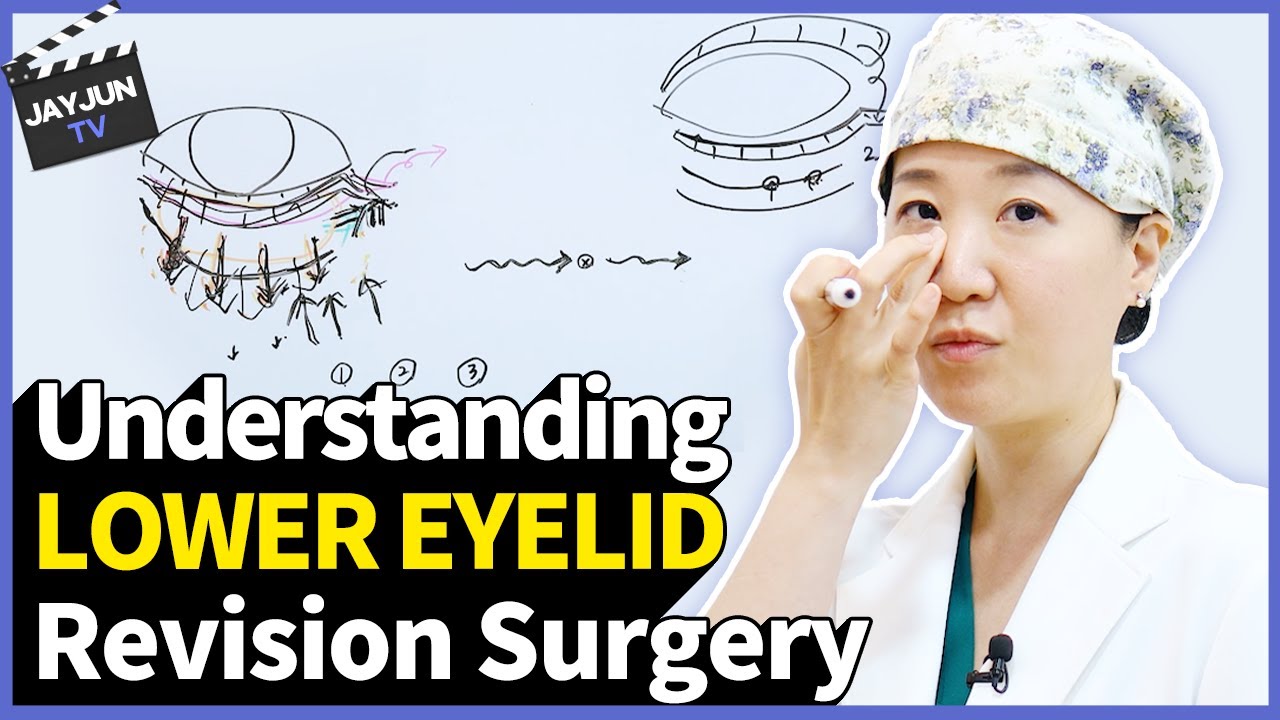 #DoubleEyelidSurgery #LowerBlepharoplasty #LowerEyelidSurgery #LowerBlepharoplastyRevision #UnderEyeSurgery #UnderEyeAesthetics #UnderEyeSagging #MidlifeEyeSurgery #KangHyungJoo #JayjunPlasticSurgeryDermatology