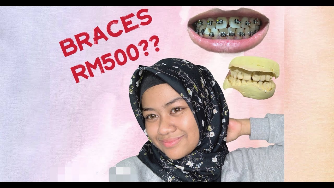 My Braces Journey! Braces RM500?? Seriouslah?! Step by step process