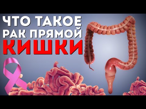 Что такое рак прямой кишки? | Болезнь от первого лица | Просто об онкологии