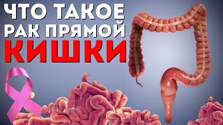 Что такое рак прямой кишки? | Болезнь от первого лица | Просто об онкологии