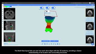 Airway volume analysis from 3D volume CBCT data
