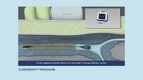 CLOSURE FAST PROCEDURE - Radiofrequency Ablation (RFA)