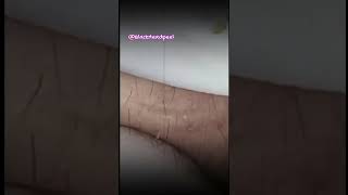 Relax Blackhead Removal 015  shorts   blackhead   acne   pimplesremoval   satisfying