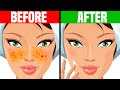 How to Get Rid of Acne OVERNIGHT